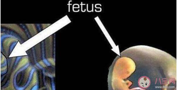 男婴腹中藏寄生胎是怎么回事 寄生胎是怎么形成的