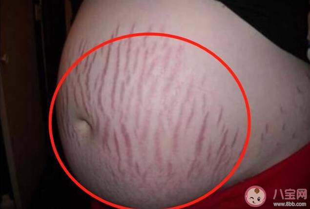 橄榄油能减淡已形成的妊娠纹吗 出现妊娠纹还能补救吗