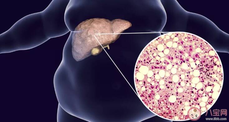 体检发现脂肪肝能调理恢复吗 体检发现脂肪肝怎么办