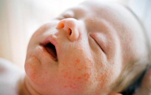 糖溜地瓜：湿疹与痱子如何区分？治疗湿疹和痱子的方法
