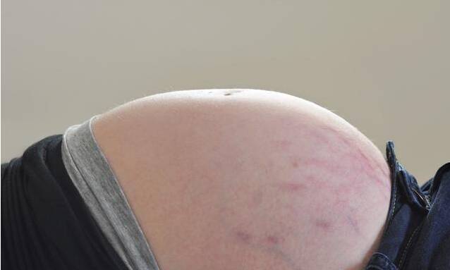 妊娠纹什么时候长 妊娠纹祛除小方法