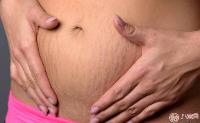 妊娠纹怎样才能消除 减轻妊娠纹的方法是什么