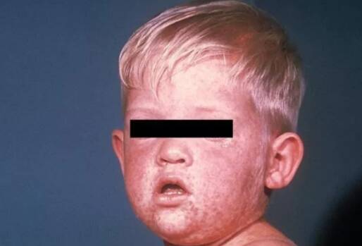 小儿麻疹怎么预防 小儿麻疹预防方法