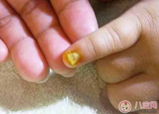 宝宝指甲盖变成黄色绿色灰色黑色 宝宝指甲盖变色怎么办