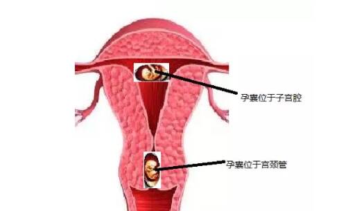 宫颈妊娠治疗难度大吗 宫颈妊娠妇科检查症状